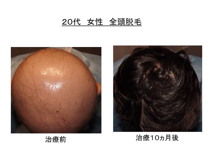 円形脱毛症　病院""